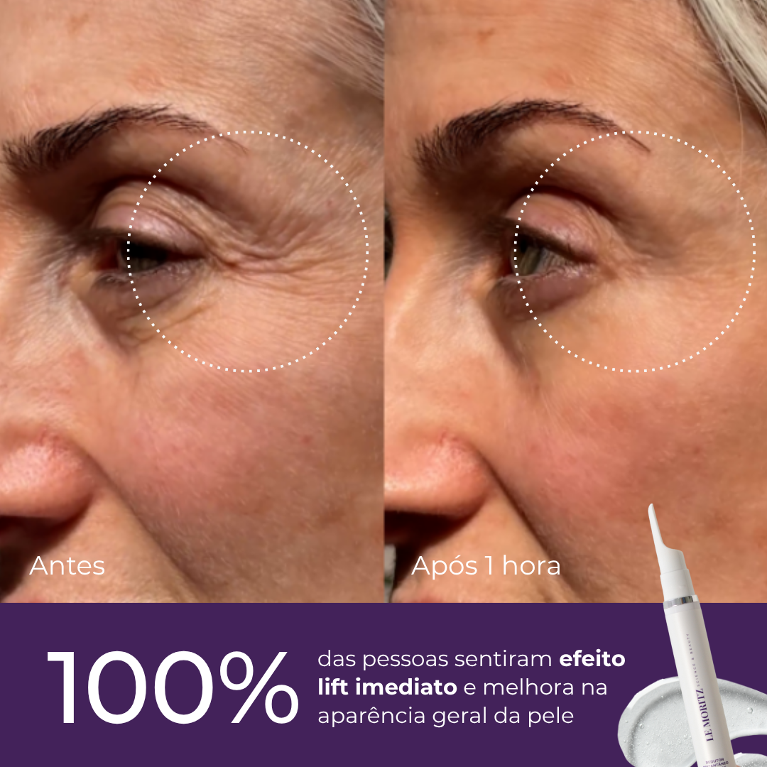 Protocolo de Rejuvenescimento Le Moritz